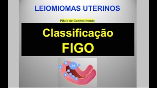 Classificação FIGO dos Leiomiomas Uterinos  Pílula de Conhecimento [upl. by Ajram]