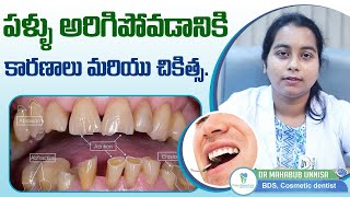 పళ్ళు అరిగిపోవడానికి కారణాలు  Tooth Wear Causes amp Treatment in Telugu  Expert Dental Care [upl. by Karel]