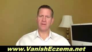 Cure Dyshidrotic Eczema Naturally  Tips on How to Cure the Burning Itching Rash and Discomfort [upl. by Jerrilee494]