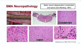 GeneTargeted Therapy for Neurodevelopmental and Neurodegenerative Disorders [upl. by Anaugahs131]