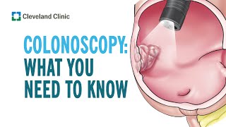 Colonoscopy What you Need to Know [upl. by Atilrahc638]