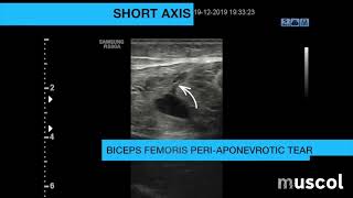 Proximal Biceps Femoris Injury grade II tear [upl. by Naamann]