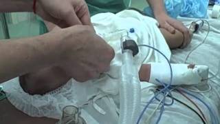 Pediatric Glidescope in Infants with LTA Stylet [upl. by Thgiled909]