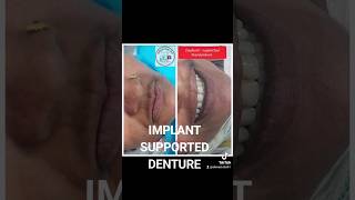 DENTAL IMPLANT SUPPORTED FULL DENTURE FOR MISSINGTEETH  OVERDENTURE SUPPORTED DENTAL IMPLANTS [upl. by Elsey629]