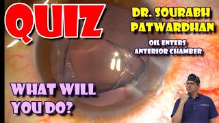 Quiz Silicone Oil in ant chamber during cataract Whatll you do Dr Sourabh Patwardhan [upl. by Irneh]