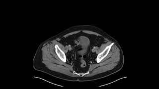 Gastric ulcer [upl. by Iman]