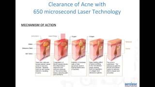 Advanced Laser Technology for Acne in Skin of Color with David J Goldberg MD JD Dermatologist [upl. by Eserehs]