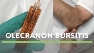 Olecranon Bursitis [upl. by Haduj]