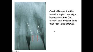 Diagnosis of Dental Caries part 3 Prof Dr Talal AlNahlawi [upl. by Helbonna]