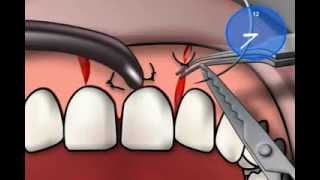 Vicryl Suture Material [upl. by Aurea]