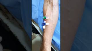 IV Cannulation subscribe cannula cannulation health hospital shortsindia [upl. by Santiago]