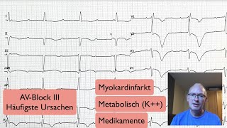 EKG Quickie AVBlock [upl. by John]