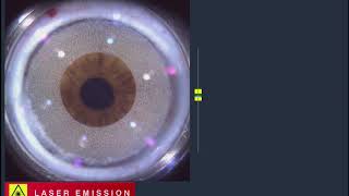 Baştan sona FemtoLasik Femto Lasik with Alcon LensX and Wavelight EX500 Excimer Laser [upl. by Marilee]