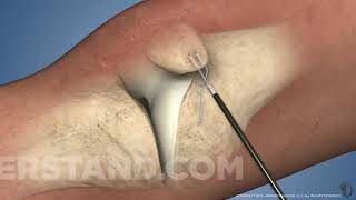 Cirurgia do Ligamento Patelofemoral medial [upl. by Sivartal]