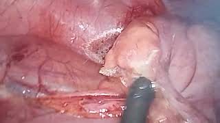 laparoscopic appendectomy in perforated retrocecal appendicitis drvikrantsinghchandail [upl. by Adirahs275]