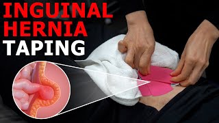 Easy Support for Inguinal Hernia A Physical Therapist’s Expert Guide [upl. by Abigael]