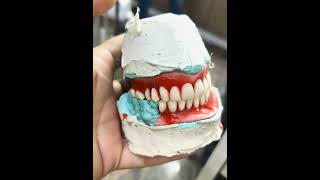 Denture For completely Edentulous Patient [upl. by Ahsinav]