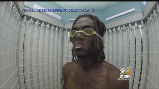 Doctor Says Vitiligo Can Be Treated [upl. by Ashbaugh]