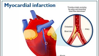 Myocardial infarction STEMIINFERIOR WALL MI amp LATERAL WALL MIECG [upl. by Shorter632]