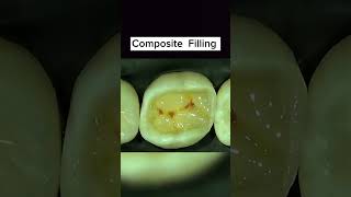 Composite Restoration Light cure restorationclass 2 composite Restoration [upl. by Manaker]