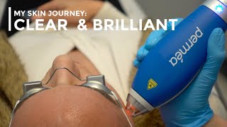 Clear amp Brilliant Permea laser treatment  Is it worth the hype [upl. by Auof]