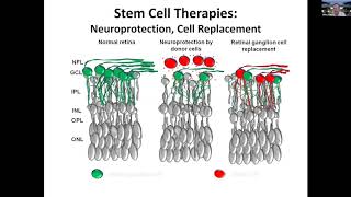 Regeneration and stem cell transplantation as treatment for optic neuropathies [upl. by Rossuck]