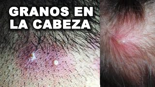 ✅🔴 Cómo Curar Granos En La Cabeza  Remedios Caseros Para Los Granos En La Cabeza [upl. by Haikan42]