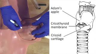 Emergency Needle Cricothyrotomy Procedure Explained [upl. by Aicissej]