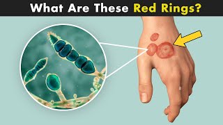 Ringworm Disease Tinea  Symptoms Causes And Treatment UrduHndi [upl. by Amaj]