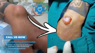 ganglion cyst removal  dr bijay  tokha horizon [upl. by Argella]