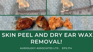 SKIN PEEL AND DRY EAR WAX REMOVAL  EP 174 [upl. by Yerak]