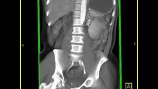 Abdomen Small Bowel Carcinoid tumor of the small bowel VRT images [upl. by Bergmans]