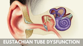 What is Eustachian Tube Dysfunction [upl. by Drye714]