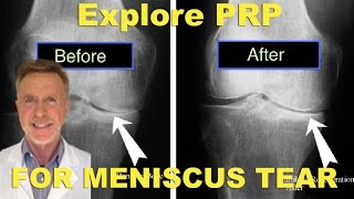 PRP for Meniscus Tear quotsurgery alternativequot [upl. by Terencio]