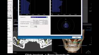 DVR Module Implant planning [upl. by Llezniuq124]