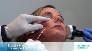 Facial Rejuvenation with PRP Injection amp PPP with Dermapen Dr Steven Weiner Destin Florida [upl. by Airamasor]