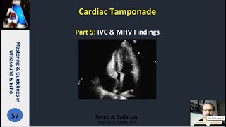 Cardiac Tamponade Part 5 IVC amp MHV Findings [upl. by Lanrev108]