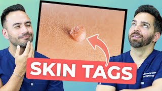 HOW TO TREAT SKIN TAGS LIKE A DERMATOLOGIST [upl. by Droc]