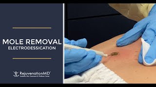 Electrodessication to Remove Seborrheic Keratosis [upl. by Tresa]