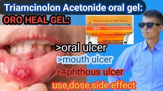 ORO HEAL gel use in nepalimouth ulcer treatmenttriamcinolone acetonide oral gel use in nepali [upl. by Yliab]