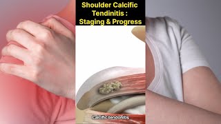 Shoulder Calcific Tendinitis  Progress and Staging [upl. by Dleifrag968]