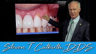 Abfraction on Tooth Colored Restorations  Dental Minute with Steven T Cutbirth DDS [upl. by Emmie]