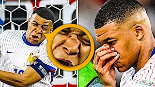 Mbappe broke his nose vs Austria 😱 [upl. by Arriaes]