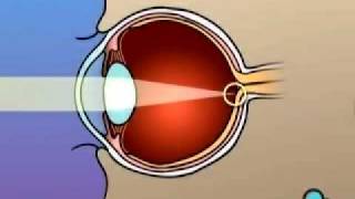 PreOp® Patient Education Lasik Laser Eye Surgery [upl. by Fornof]