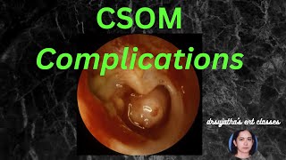 037 Complications of Suppurative Otitis Media csom [upl. by Snyder]