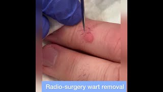 Wart Removal by Radiosurgery  Quick amp Thorough Removal of Stubborn Finger Warts [upl. by Iren]