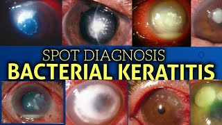 Bacterial keratitis  clinical features [upl. by Garber]