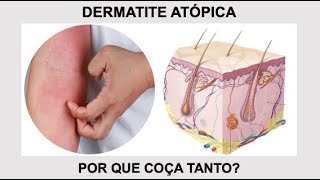 Por que a DERMATITE ATÓPICA coça tanto Por Luiz Gameiro médico dermatologista [upl. by Coveney]