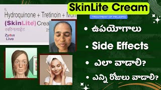 How to Use Skinlite Cream for Melasma  Benefits Side Effects and Precautions [upl. by Cathrine]