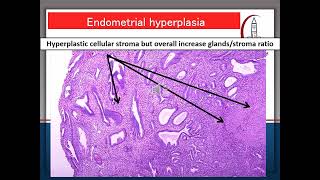 Benign Prostatic Hyperplasia BPH An Overview  Urology Care Podcast [upl. by Bounds894]